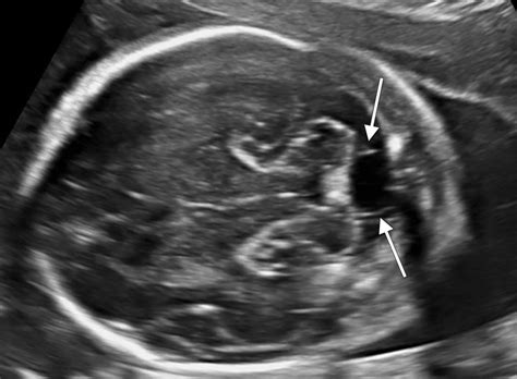 cisterna magna fetal ultrasound.